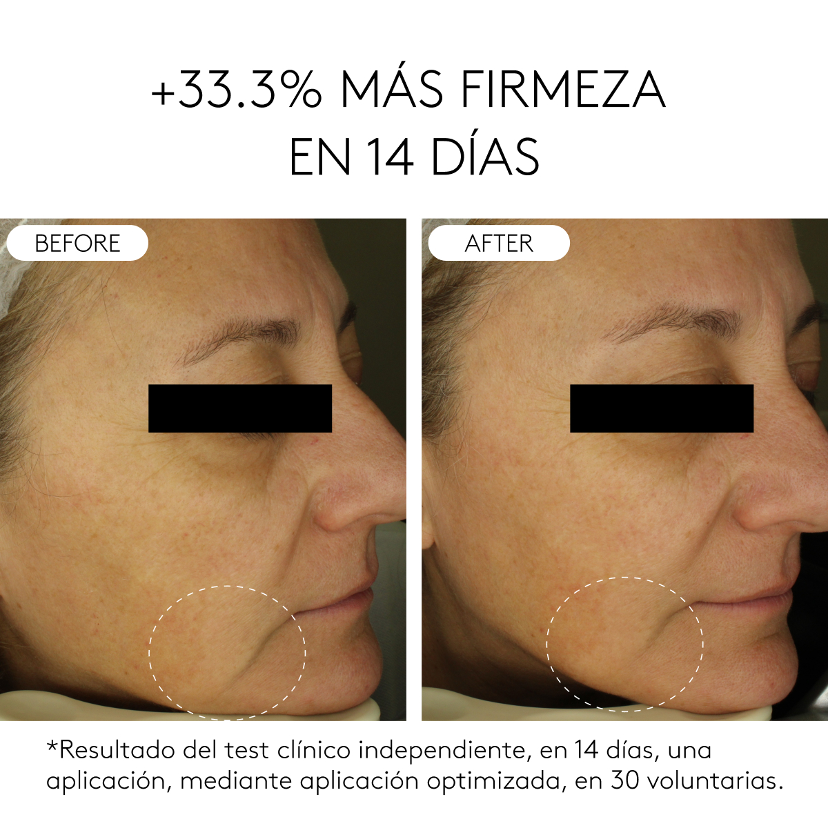 CLINICAL BEAUTY FILLER | 2 MESES before and after